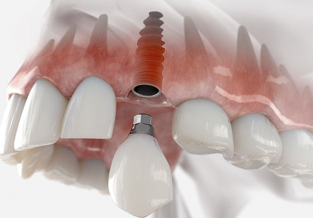dental-implant1